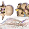 Epidural in the spinal chord